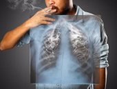 التهاب الشعب الهوائية المزمن أكثر الأمراض شيوعا بين المدخنين