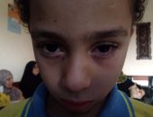 تفاصيل إصابة تلميذ لزميله بشرخ فى القرنية داخل مدرسة خاصة بالقليوبية