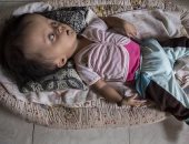 بالصور.. طفلة إندونيسية تعيش برأس "عملاق" بسبب مرض نادر