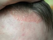 3 أمراض جلدية معدية تصيب الشعر وفروة الرأس أبرزها الجرب والصدفية