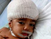 خلافات الضرائر تصيب طفلا بنزيف فى المخ بالشرقية