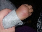تداول صور على "فيس بوك" لطفلة 3 سنوات تعرضت للضرب من مدرس بحضانة فى البحيرة