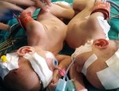 فصل طفلتين ملتصقتين الكبد وعظام الصدر فى مستشفى الأطفال الجامعى بأسيوط