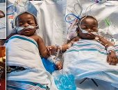بالصور.. خضوع توأم ملتصق من الحوض لعملية فصل استغرقت 18 ساعة