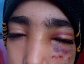 إصابة تلميذة بتورم وكدمات فى العين نتيجة إهمال مدرسة فى الشرقية