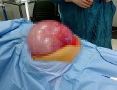 بالصور.. فريق طبى بمعهد جنوب مصر للأورام ينجح فى استئصال ورم يزن 25 كجم