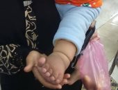 بالصور..مأساة أم بالشرقية تعجز عن توفير جورب طبى لطفلتها المصابة بمرض نادر