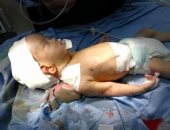 لأول مرة بمستشفيات السويس.. إجراء عملية جراحية كبرى بالمخ لطفل عمره 27 يوما