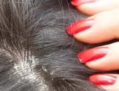 4 وصفات طبيعية تخلصك من قشرة الشعر.. تعرفى عليها