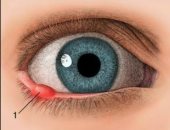 أستاذ طب عيون يكشف عن تقنية جديدة لعلاج الأكياس الدهنية بالعين