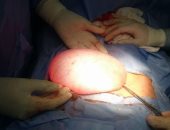 بالصور.. طبيب ينجح فى استئصال كيس يزن 5 كيلو من مبيض فتاة بنجع حمادى