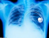 الحكومة الأمريكية تحذر: أجهزة تنظيم نبضات القلب سهلة الاختراق