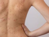 3 علاجات طبيعية للتخلص من حب الشباب بمنطقة الظهر