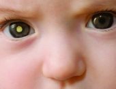 طبيبة عيون:  6 % من الأطفال يولدون بانسداد فى القناة الدمعية