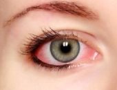 أعراض الإصابة بحساسية العين الموسيمية وطرق الوقاية منها