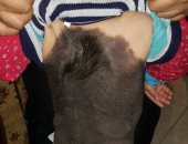 مرض نادر يصيب طفلا فلسطينيا ووالده يناشد أصحاب القلوب الرحيمة علاجه