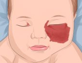 الوحمات الدموية لحديثى الولادة.. الأسباب وطرق العلاج