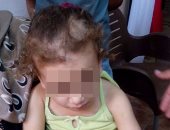 إحالة الأم المتهمة بتعذيب طفلتها الصغرى بـ"الكى" بمنيا القمح للجنايات