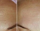 وصفة طبيعية للتخلص من التجاعيد فى 7 أيام