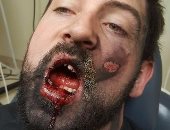 بالصور.. سيجارة إلكترونية تنفجر فى فم رجل وتدمر 7 من أسنانه وتحرق وجهه