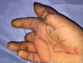 نجاح جراحة لتثبيت إصبعى طفل تعرضا للبتر بمستشفى الأزهر بدمياط
