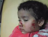 بالصور.. الكلاب الضالة تعقر طفلين بالسويس