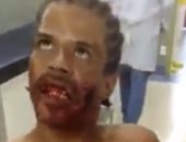 بالفيديو والصور.. "زومبى برازيلى" يرعب الأطباء بإحدى مستشفيات ريو دى جانيرو