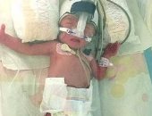 نجاة طفلة ولدت بحجم أصغر من نصف كيلوجرام بعد أشهر من المعاناة