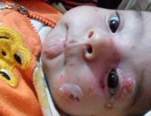 الجلد الفقاعى يهدد حياة الطفل "أدم".. والأب: علاجه يتكلف 1500 جنيه شهريا