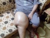 بالفيديو والصور..معاناة محمود مع مرض "الناعور " ..جسده لا يتوقف عن النزيف