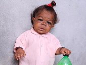 بالصور.. هندى عمره 21 عاما يشبه الرضيع احتاروا فى تشخيصه فعبدوه