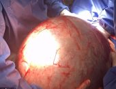 استئصال ورم سرطانى وزنه 20 كيلو لعجوز بالمنيا