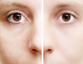 وداعاً لالتهابات البشرة..ماسك العسل والليمون هو الحل