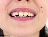 دراسة تحذر: إعوجاج أسنان الطفل علامة على سوء التغذية