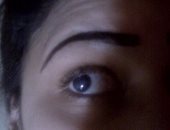 "مى" اقترب زفافها ولا ترى بعينها اليسرى وتحتاج إجراء عملية على نفقة الدولة