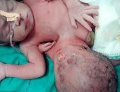 طفل هندى يولد برأس إضافية ملتصقة ببطنه بدون أذنين ولا عيون