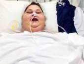 مدير مستشفى برجيل: تحسن حالة أسمن امرأة فى العالم بعد إزالة أنبوب المعدة