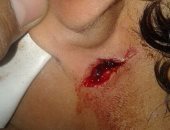 إصابة عاطل بجرح قطعى بالشريان الرئيسى بالرقبة فى مشاجرة بالبحيرة