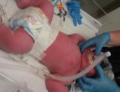 بالصور.. ولادة طفل نيوزيلندى يزن 7.39 كيلو