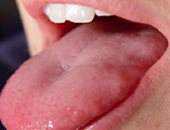 سرطان الفم مرض خبيث يبدأ بقروح على الوجه والرقبة