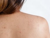 4 وصفات طبيعية لعلاج حب الشباب فى الظهر 