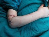 بالصور.. فريق طبي يستعيد ذراع مبتورة لطفلة عمرها ثلاث سنوات بدمياط