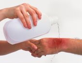 من غير أدوية..عالجى الحروق بـ 5 حاجات من مطبخك "بياض البيض أهمها"