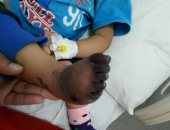 عرض طفل على الطب الشرعى لإصابته بغرغرينة بالقدم نتيجة إهمال طبى بأكتوبر