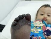 طفل يفقد قدمه نتيجة إهمال طبى فى مستشفى بأكتوبر