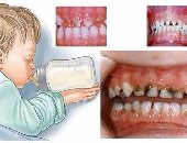 نصائح للتعامل مع تسوس أسنان الأطفال اللبنية