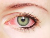 علاج احمرار العينين بالقطرات حسب استشارة الطبيب