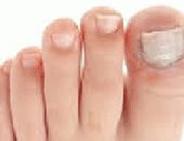 تعرف على أسباب انتشار الفطريات بين أصابع القدمين وطرق علاجها