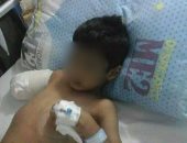 مأساة.. بتر ذراع طفل بسبب إهمال طبيب بمستشفى سمالوط العام فى المنيا