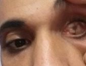 بالصور.. مأساة مواطن دخل مستشفى بالغربية لتركيب عدسة بعينه فخرج بواحدة فقط